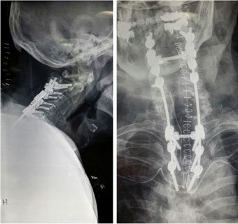 Rrezet X postoperative që përshkruajnë fuzionin posterior nga vertebra e 2-të cervikale deri te vertebra e 4-t torakale.
