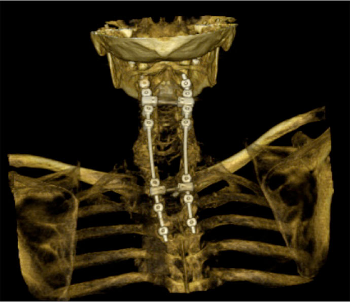 Rikonstruksioni tredimensional i zonës cervikale të shtyllës kurrizore dhe tomografia e zonës torakale të shtyllës kurrizore që përshkruan fuzionin posterior nga vertebra e 2-të cervikale deri te vertebra e 4-të torakale.