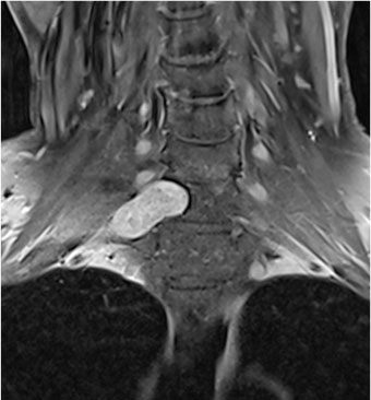 Imazheria e rezonancës magnetike të zonës cervikale përpara operacionit që tregon pjesën e neurinomës që shtrihet përtej shtyllës kurrizore dhe që ndodhet shumë pranë nervave dalës