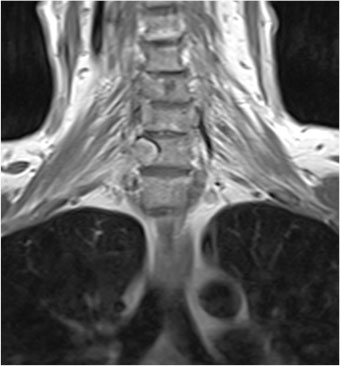 Postoperative cervical magnetic resonance imaging depicting complete removal of the neurinoma