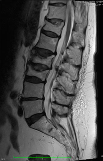 Imazheria e rezonancës magnetike të zonës lumbare të shtyllës kurrizore përpara operacionit që tregon frakturat vertebrale lumbare.