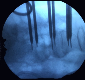 Intraoperative X-ray depicting the placement of the special needles inside fractured vertebral bodies. The special bone "cement" shall be injected through these needles.
