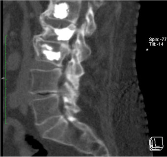 Postoperative lumbar spine tomography, which depicts the correct injection of bone cement (strongly white material) inside the bodies of those lumbar vertebrae presenting with a fracture, thus offering spinal stability and pain relief.