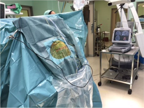 Konfigurimi OR përpara kryerjes së një prerjeje kirurgjike. Për një orientim të saktë kirurgjik, neuronavigimi përdoret në mënyrë intraoperative.