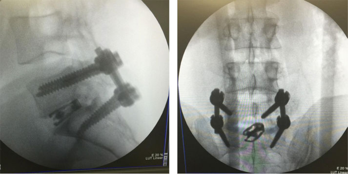 Intraoperative X-rays, which confirm the correct placement of the fusion materials.