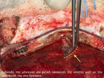 Radical excision of the cyst along with its adherence to the cerebral falx